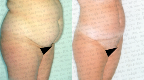 addominoplastica4