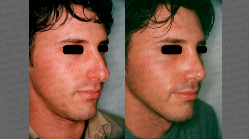 rinoplastica29