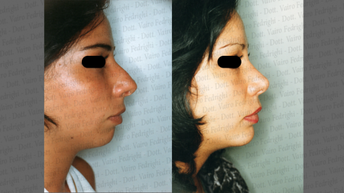 rinoplastica32