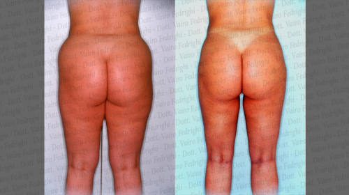 liposuzione1