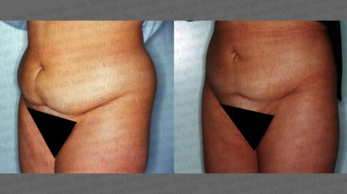 liposuzione10
