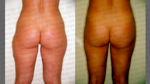 liposuzione11