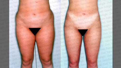 liposuzione12