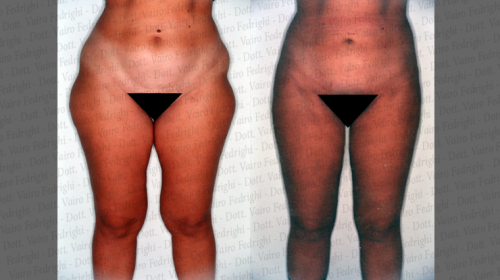 liposuzione13