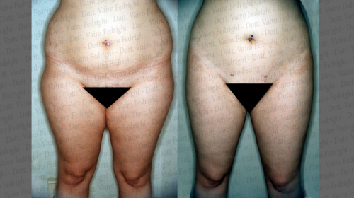 liposuzione14