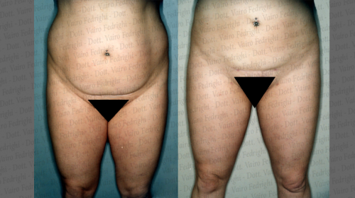 liposuzione15