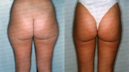 liposuzione16