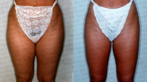 liposuzione17