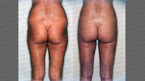 liposuzione2