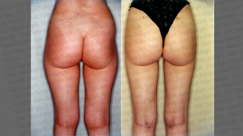 liposuzione3