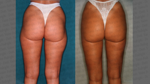 liposuzione4