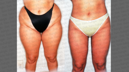 liposuzione5