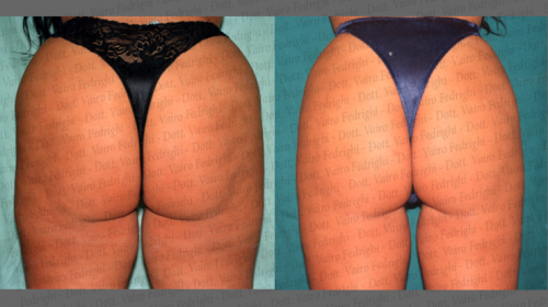 liposuzione7