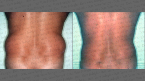 liposuzione8
