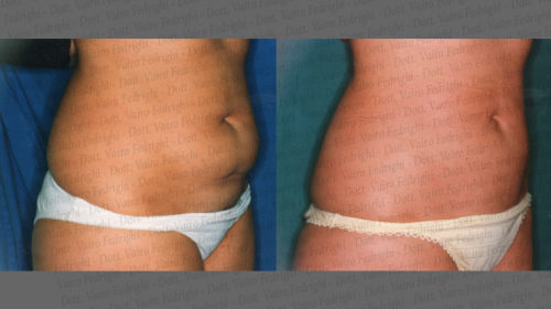 liposuzione9