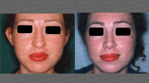otoplastica1